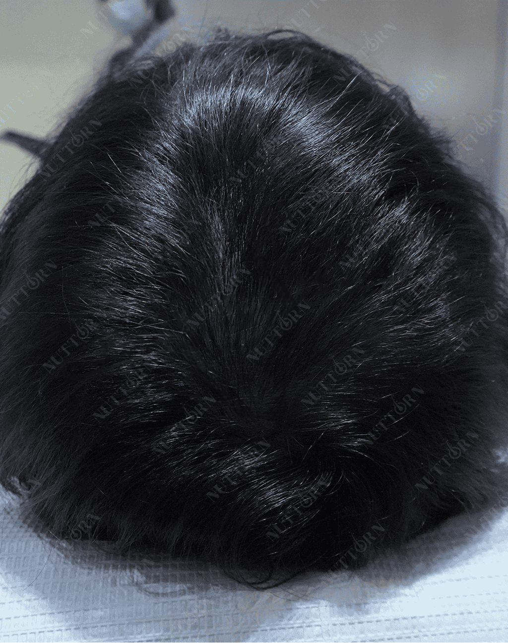 After ALMI Nanofat Treatment