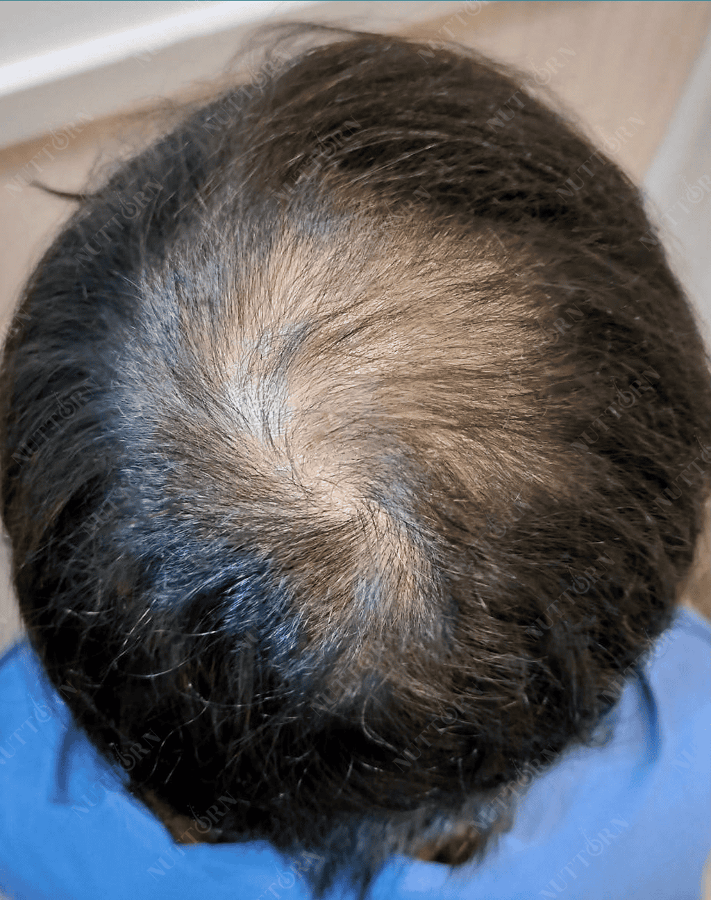 Before ALMI Nanofat Treatment