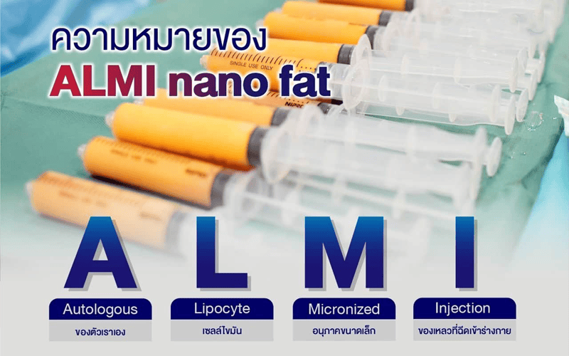 ALMI Nanofat Transfer