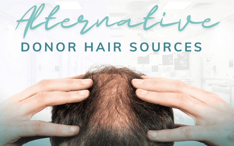 Alternative donor hair sources for FUE/DHI hair transplants from chest, beard, back, and leg hair.