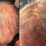 Before and after hair restoration showing increased density and natural look.