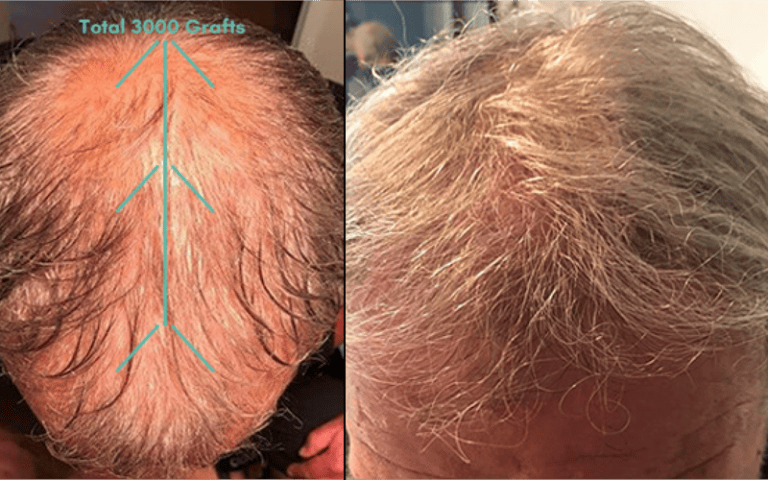 Before and after hair restoration showing increased density and natural look.