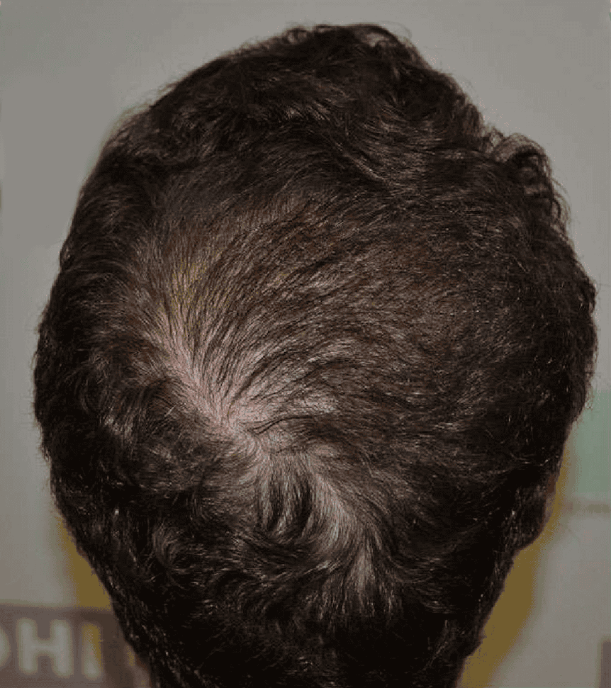 After Exosome Rich Plasma (ERP)