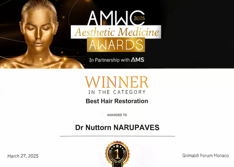 Krit receiving hair restoration treatment at Nuttorn Hair Centre.