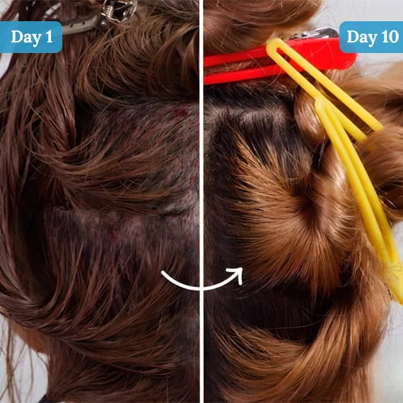 Long Hair donor area after Hair Transplant