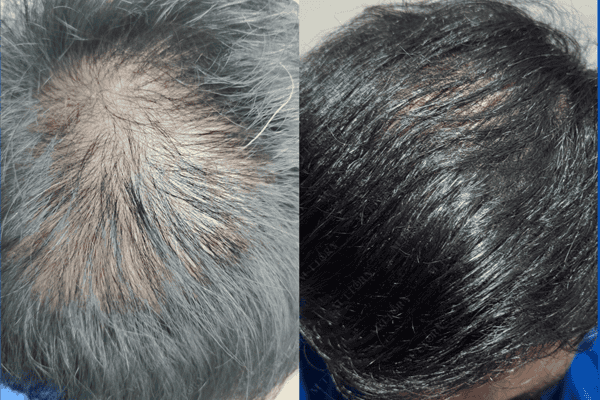 Regenera Activa results