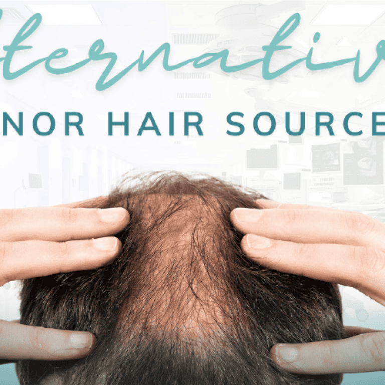 Alternative donor hair sources for FUE/DHI hair transplants from chest, beard, back, and leg hair.