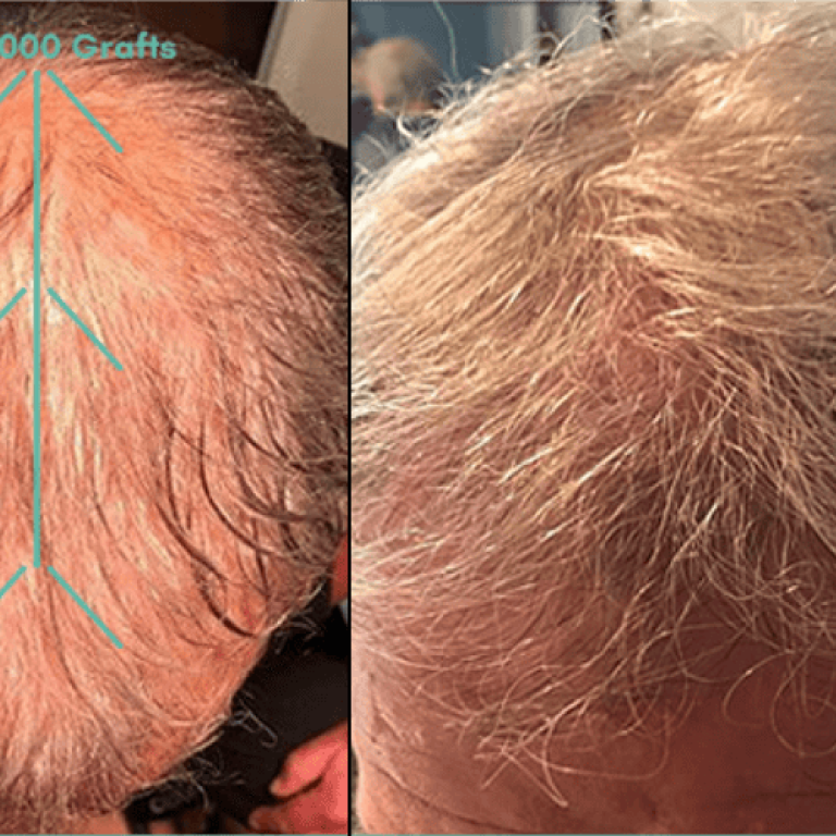 Before and after hair restoration showing increased density and natural look.