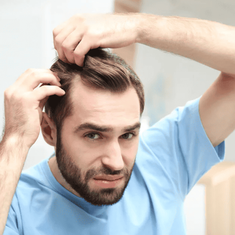 Male scalp with thinning hair, hair restoration, hair loss kezelÃ©s, hair growth treatment.