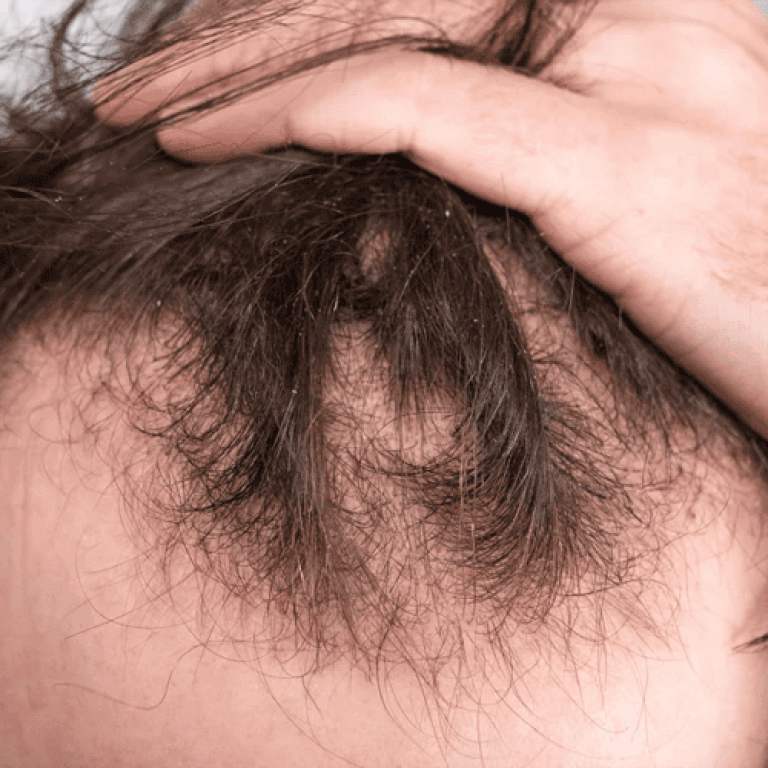 Close-up of male scalp showing hair thinning and hair loss issue.