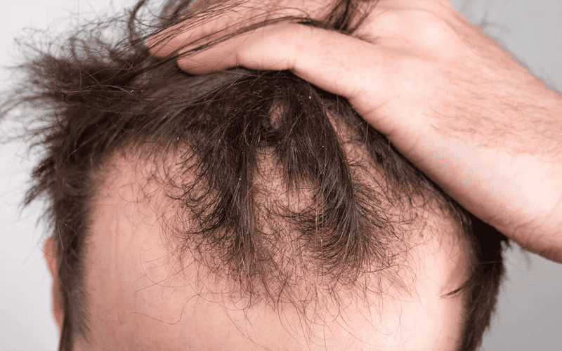 Close-up of male scalp showing hair thinning and hair loss issue.